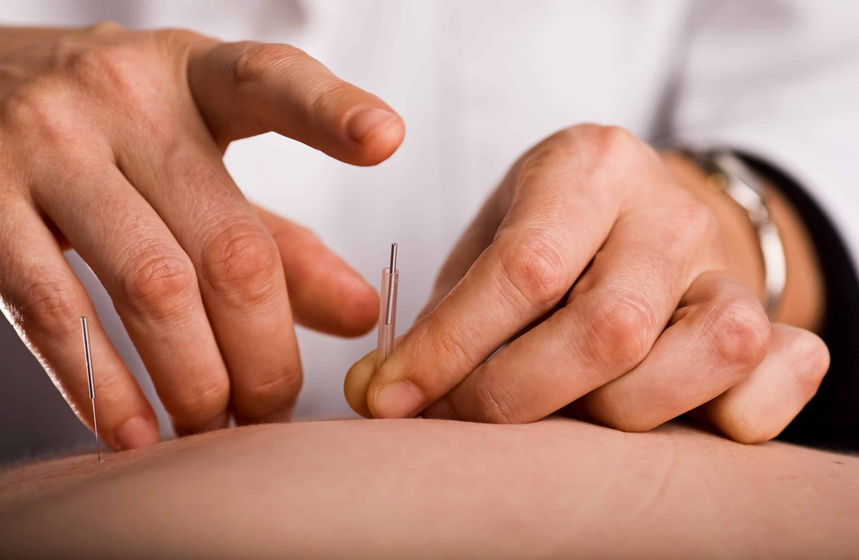 Acupuncture for Addiction Treatment?